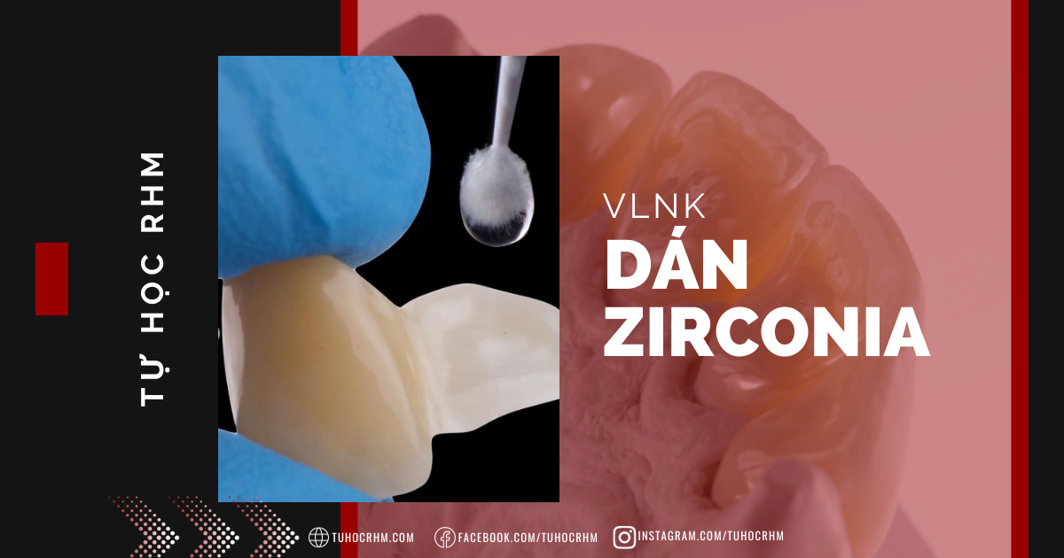 Abutment Implant Nha Khoa: Phân Loại & So Sánh Vật Liệu (2026)