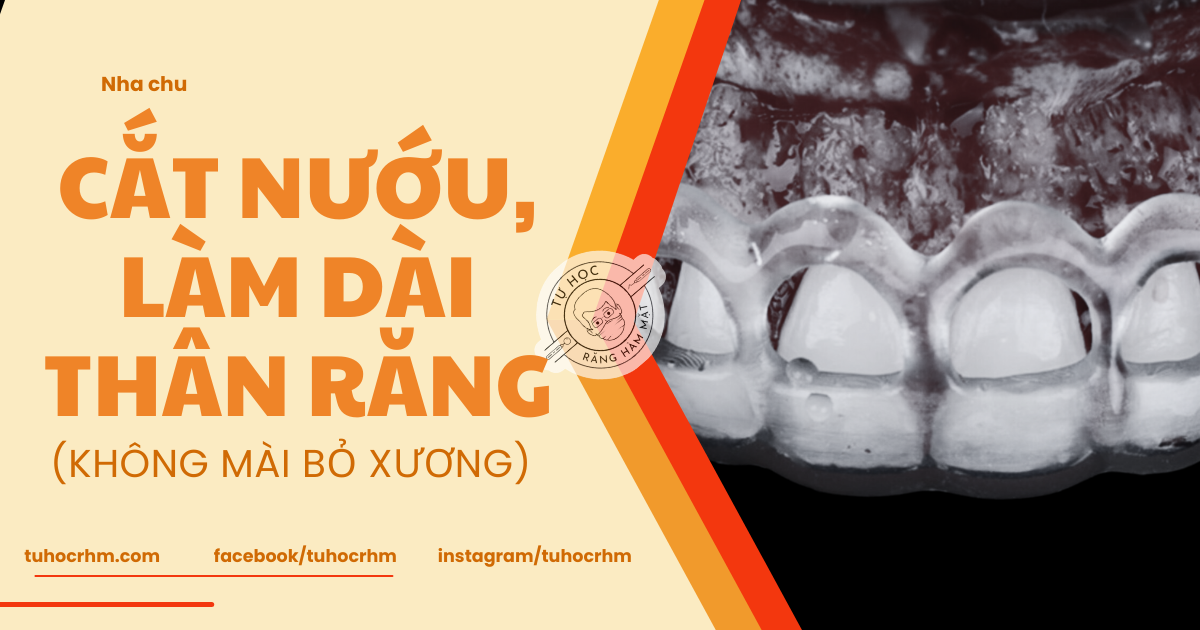 Phẫu Thuật Cắt Nướu Làm Dài Thân Răng: Quy Trình Lâm Sàng (2026)