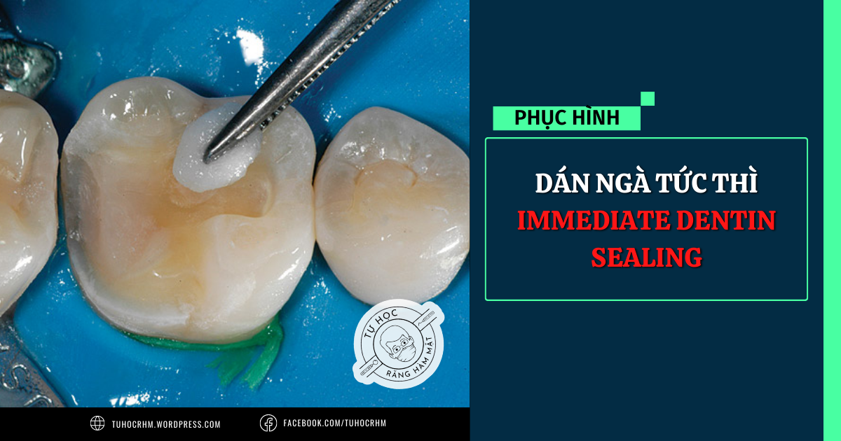 Dán Ngà Tức Thì (IDS): Quy Trình & Ứng Dụng Trong Phục Hình (2026)