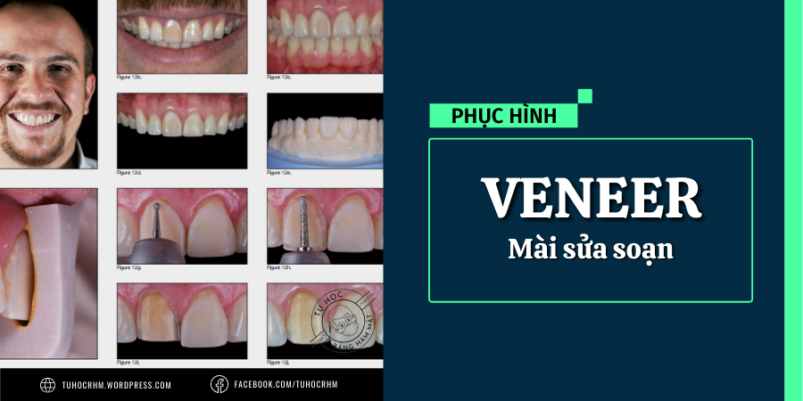 Kỹ Thuật Mài Sửa Soạn Veneer Sứ: Từ Kính Áp Tròng Đến Mài Toàn Phần (2026)