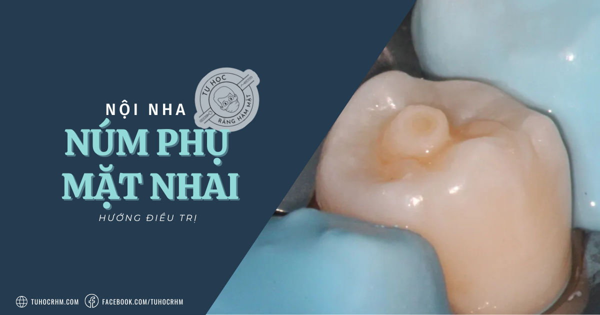 Núm Phụ Mặt Nhai (Dens Evaginatus): Phân Loại & Điều Trị (2026)