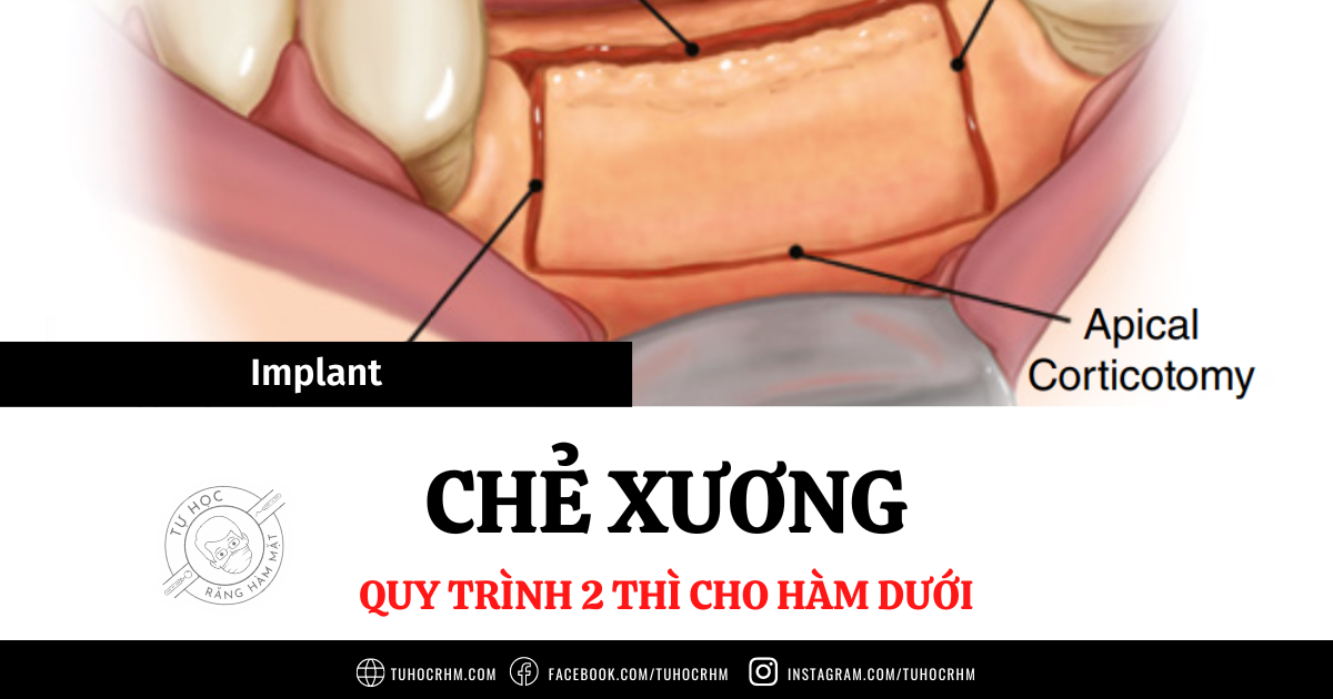 Chẻ Xương 2 Thì Hàm Dưới: Quy Trình Kỹ Thuật & Ca Lâm Sàng (2026)