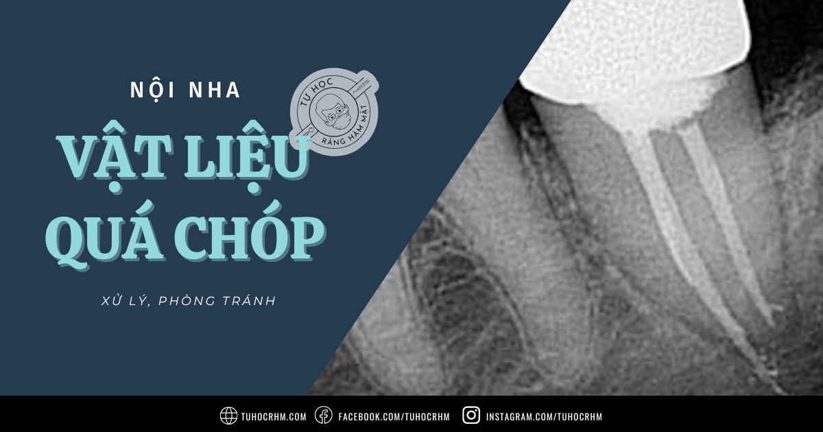Xử Lý Vật Liệu Quá Chóp Trong Nội Nha: Nguyên Nhân & Khắc Phục (2026)