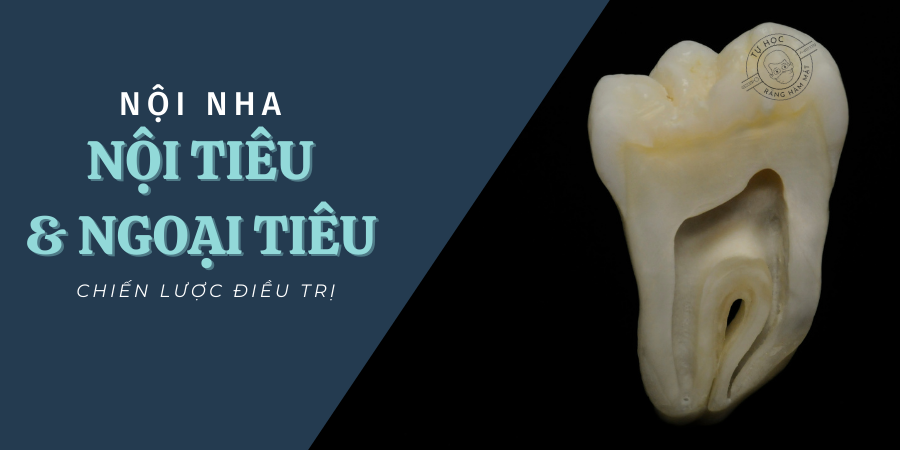 Nội Tiêu Và Ngoại Tiêu Chân Răng: Chẩn Đoán & Điều Trị (2026)