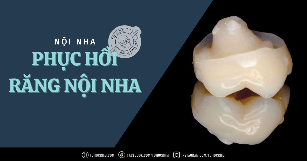 Phục Hồi Răng Sau Nội Nha: Ferrule & Chốt Sợi (2026)