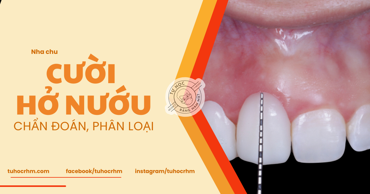 Cười Hở Nướu: Chẩn Đoán, Phân Loại APE Và Điều Trị (2026)