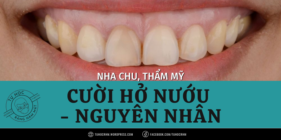 Cười hở nướu: 6 nguyên nhân và Sơ đồ chẩn đoán lâm sàng