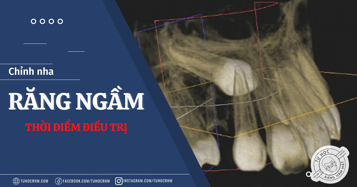 Thời Điểm Điều Trị Răng Ngầm Trong Chỉnh Nha (Cập Nhật 2026)