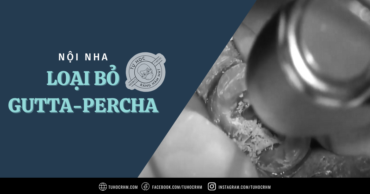 Cách Loại Bỏ Gutta-Percha Trong Điều Trị Nội Nha Lại (Cập nhật 2026)