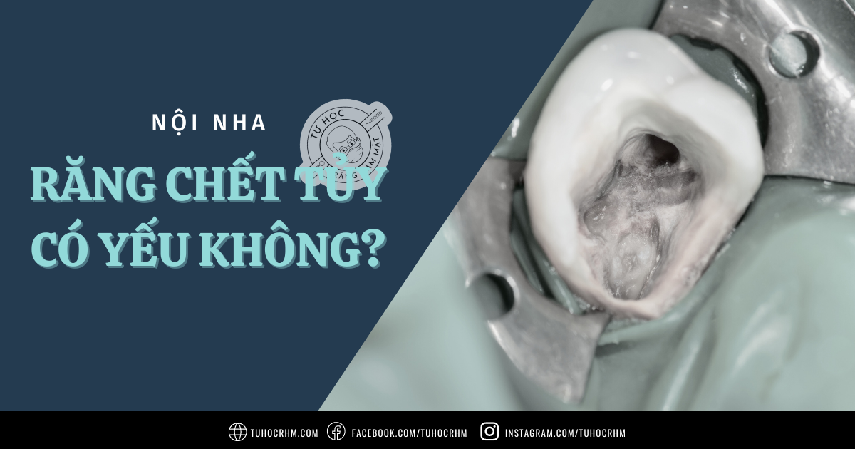 Răng Chết Tủy Có Yếu Không? Sự Thật Về Độ Bền Sau Nội Nha (2026)