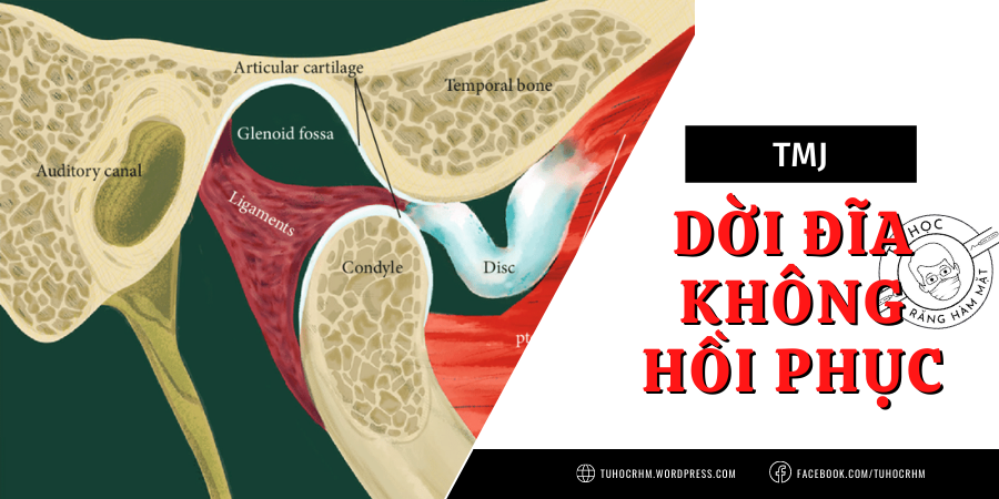 TMJ: Dời Đĩa Khớp Không Hồi Phục - Chẩn Đoán & Điều Trị (2026)