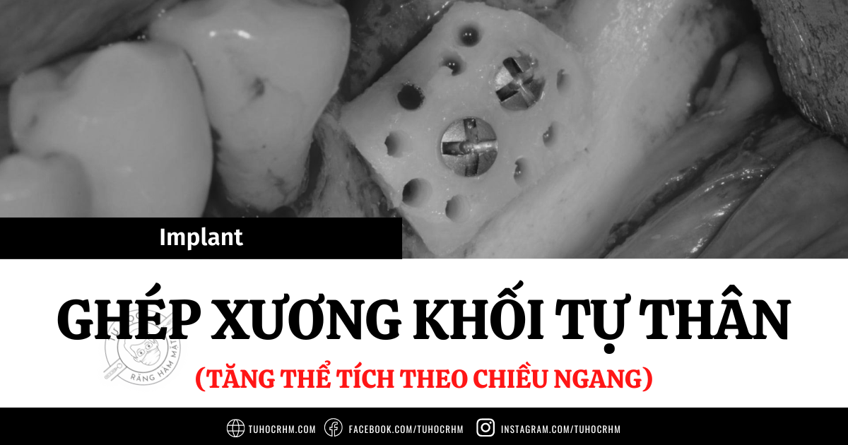 Vị Trí Đặt Implant So Với Mào Xương & Khái Niệm Zero Bone Loss (2026)