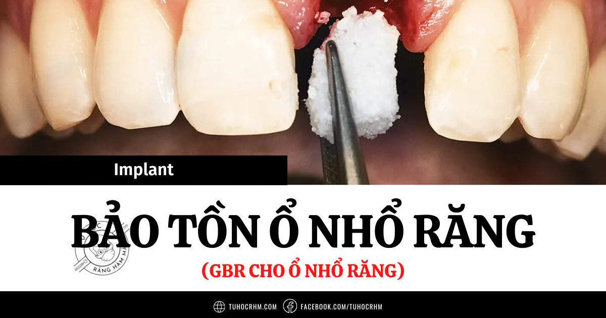 GBR Ổ Nhổ Răng: Kỹ Thuật Bảo Tồn Gờ Xương Tránh Tiêu Xương (2026)