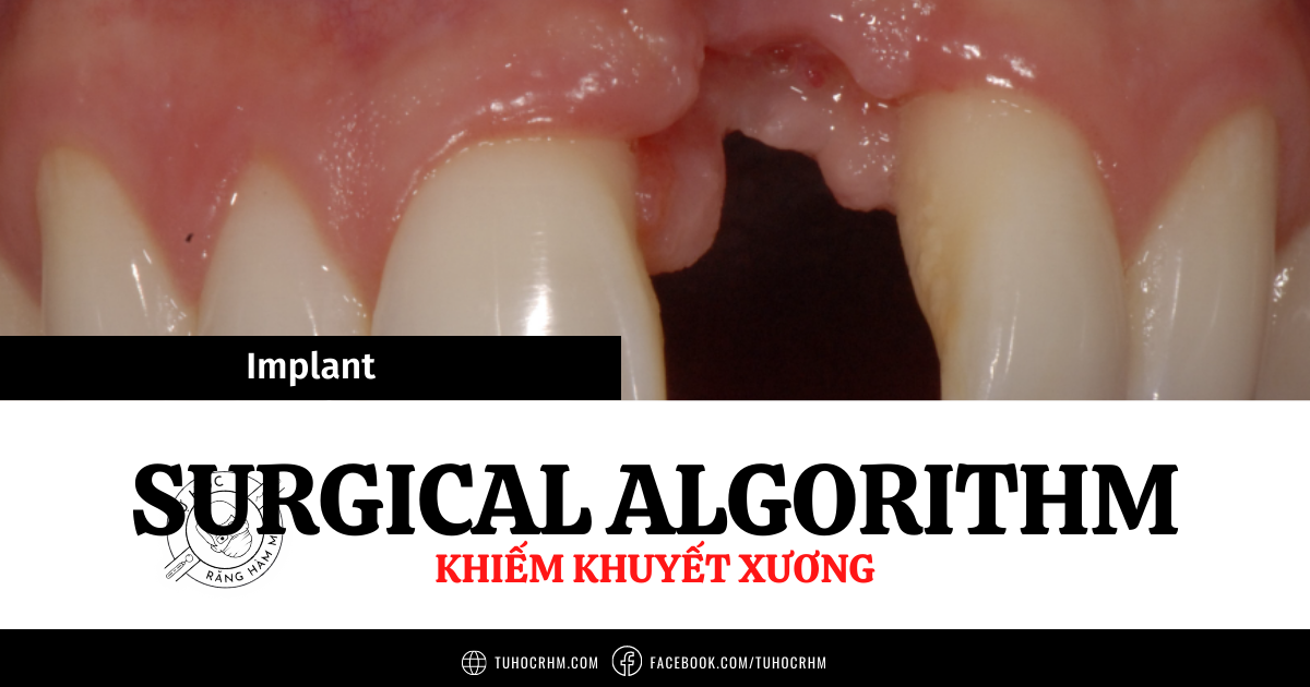 Khiếm Khuyết & Tăng Thể Tích Xương Implant: Cách Tiếp Cận (2026)