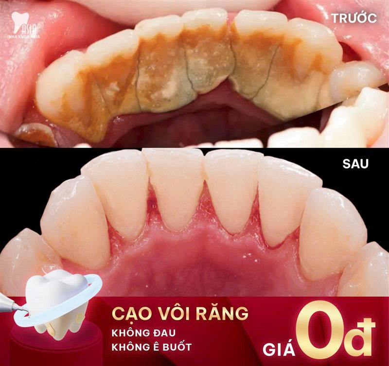 Cạo vôi răng & Đánh bóng